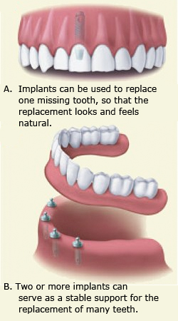 dental implant images