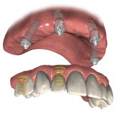 DIEM dental implants