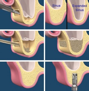 illustration of sinus lift procedure