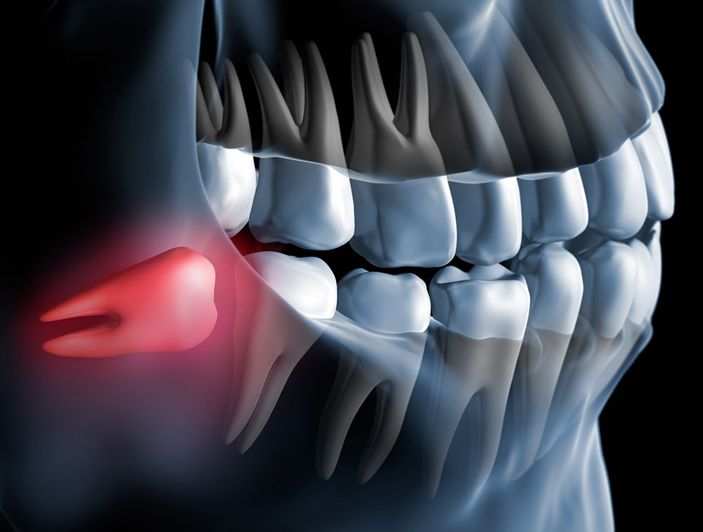 wisdom tooth removal